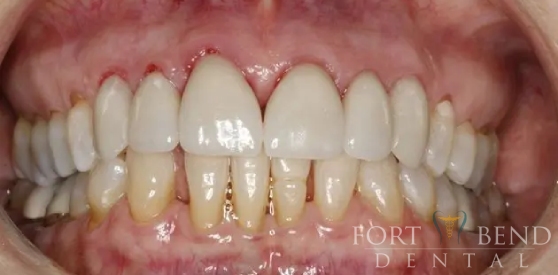 teeth after dental crown replacement