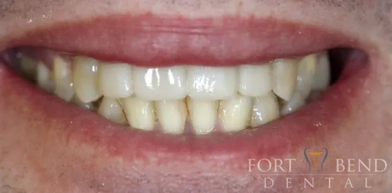 teeth after dental crowns and bridges