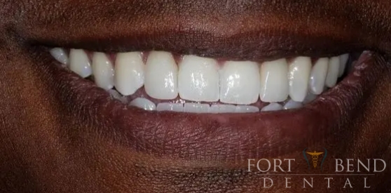 teeth after dental crowns