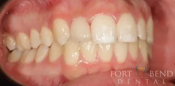 teeth after dental crowns