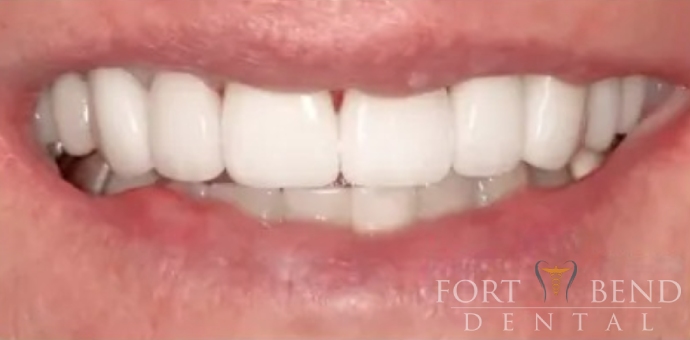 teeth after dental crowns and veneers