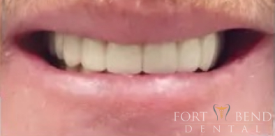 after Esthetic Crowns