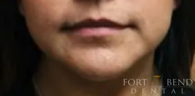 Masseter Botox for Teeth Grinding, after treatment