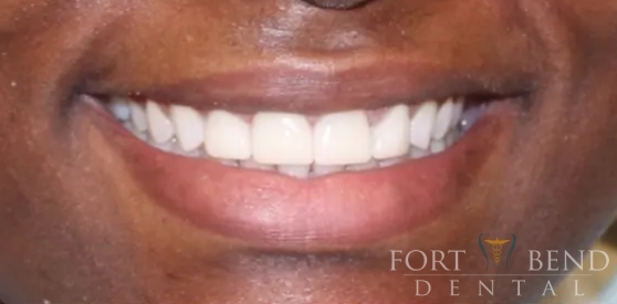 after replace anterior crowns procedure