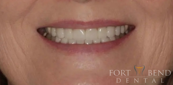 before smile makeover