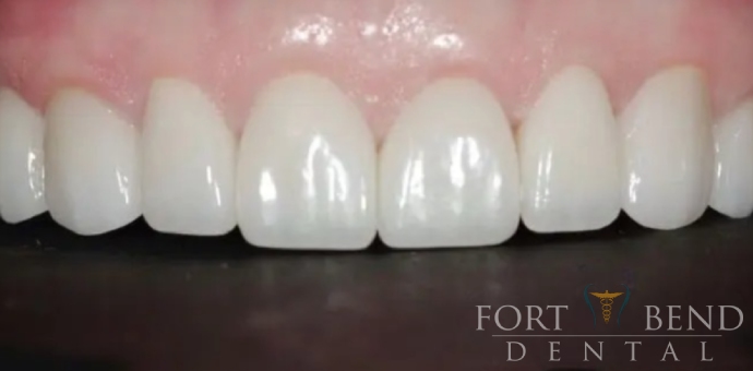 before Cosmetic Smile Makeover