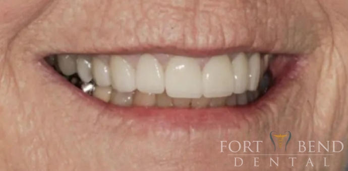 after smile makeover