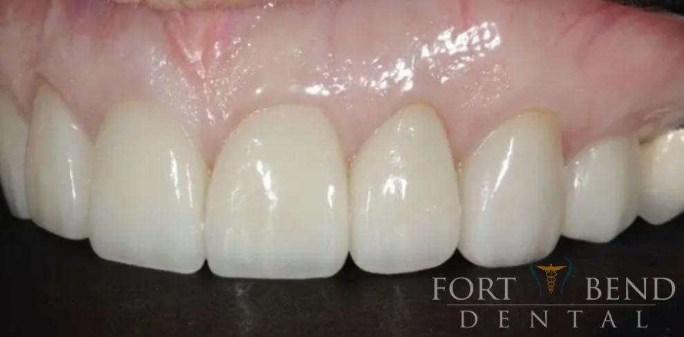 after smile makeover