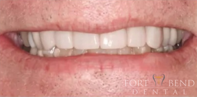 before smile makeover