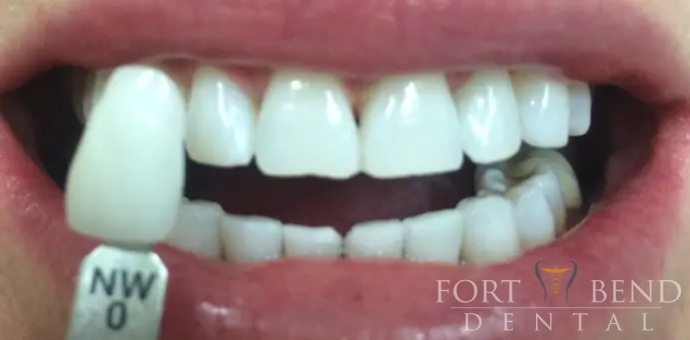 after teeth whitening