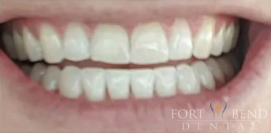 after teeth whitening