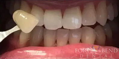 after teeth whitening