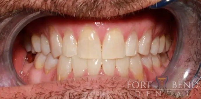 after teeth whitening