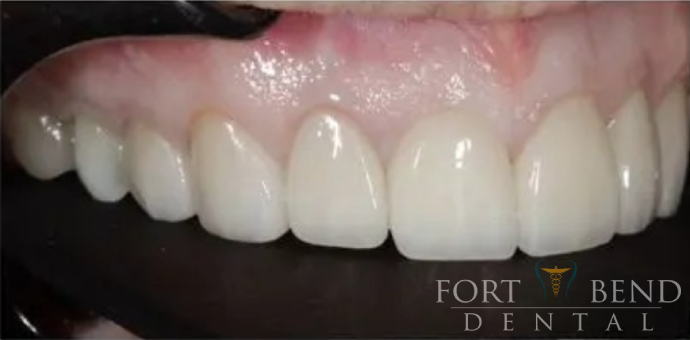 Teeth after veneers treatment