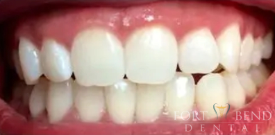 after teeth whitening