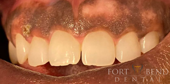 Before Laser Depigmentation