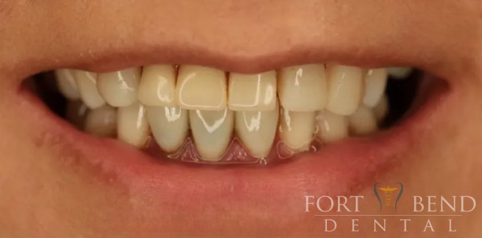 before Anterior Bridge