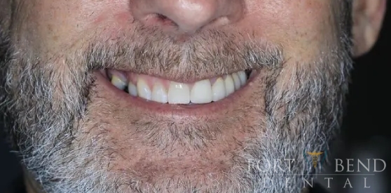 teeth before dental bridge