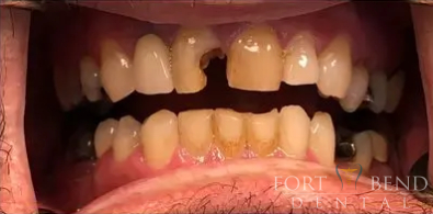 before Cerec - Crowns in a Day!!