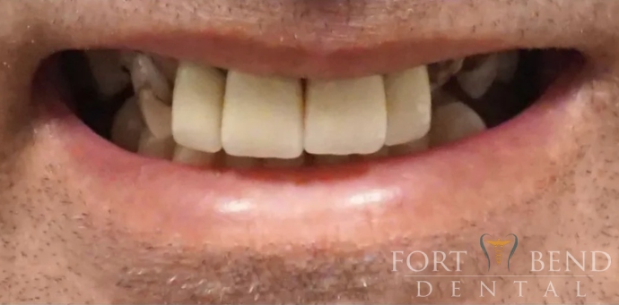 before dental crowns