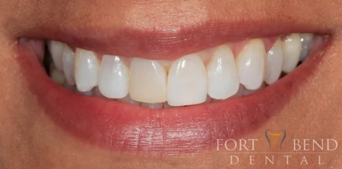 before dental crowns