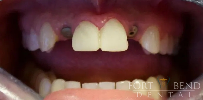 before anterior implant crowns and esthetic crowns