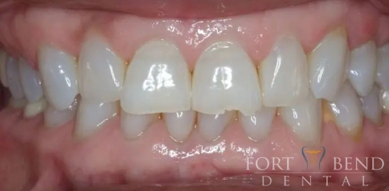 before Porcelain Crown Restoration