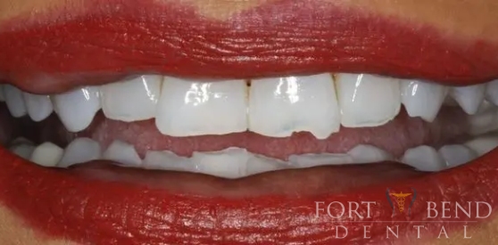 before Porcelain Crown Restoration