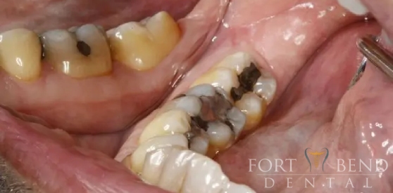 Failing Silver Filling, before treatment