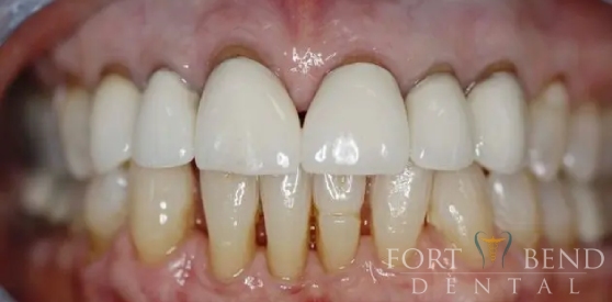 teeth before dental crown replacement