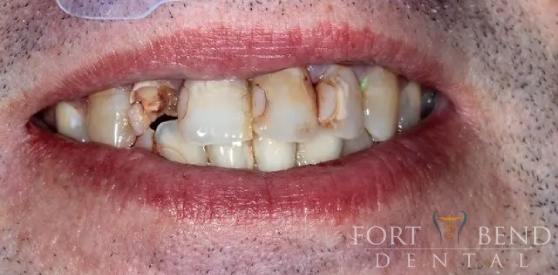 teeth before dental crowns and bridges