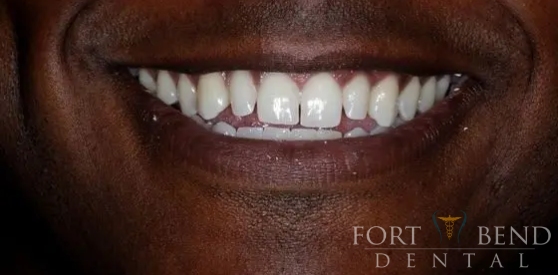 teeth before dental crowns