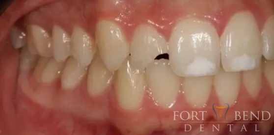 teeth before dental crowns