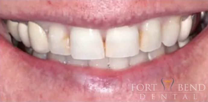 teeth before dental crowns and veneers