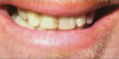 before Esthetic Crowns