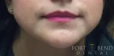 Masseter Botox for Teeth Grinding, before treatment