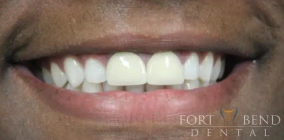 before replace anterior crowns procedure