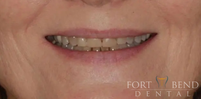 before smile makeover