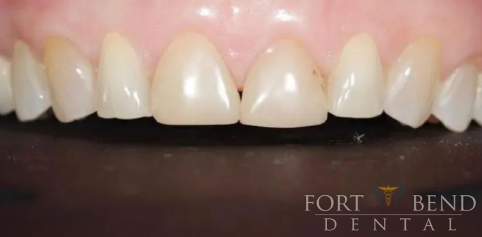after Cosmetic Smile Makeover
