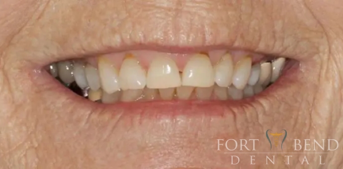 before smile makeover