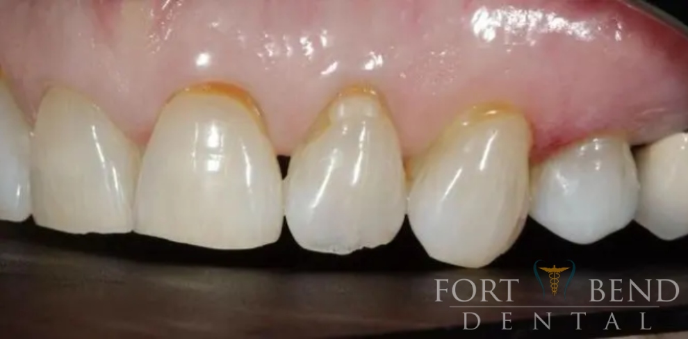 before smile makeover