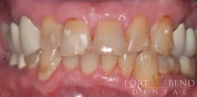 before smile makeover