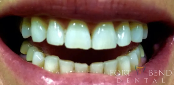 before teeth whitening