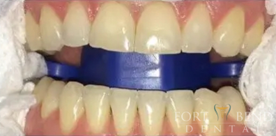 before teeth whitening