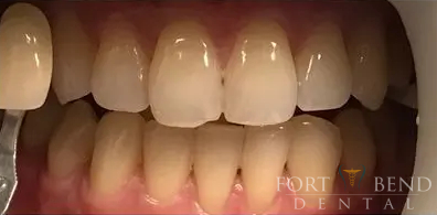 before teeth whitening