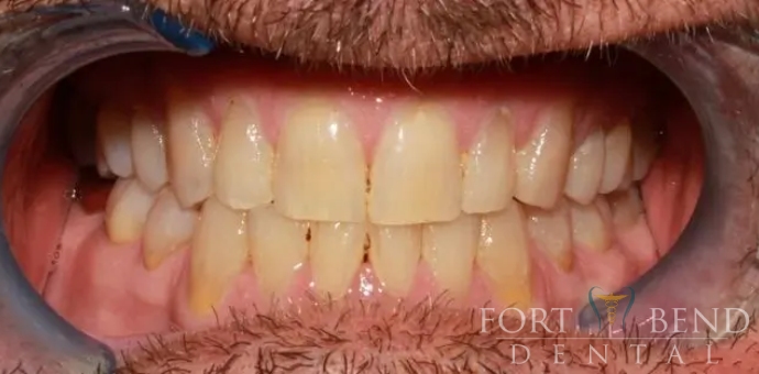 before teeth whitening