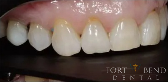 Teeth before veneers treatment