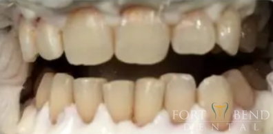 before teeth whitening
