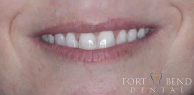 after Botox Treatment to Correct Gummy Smile