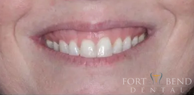before Botox Treatment to Correct Gummy Smile